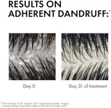 Vichy Dercos Anti-Dandruff Shampoo (Normal to Oily Hair) - 390ml