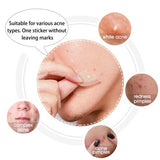 Hydrocolloid Acne Patch (20 Patches) - Large Spot Control Cover for Body, Cheek, Forehead, and Chin