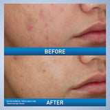 CeraVe Acne Foaming Cream Wash with Benzoyl Peroxide 10%, Hyaluronic Acid & Niacinamide - 5 oz