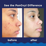 PanOxyl Acne Foaming Wash 10% Benzoyl Peroxide - Maximum Strength Antimicrobial - 5.5 Oz