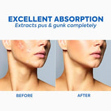 JUJUYN Pimple Patch for Face - 36 Hydrocolloid Acne Stickers | Ultra-Thin Invisible Spot Treatment for All Skin Types