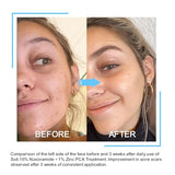 Niacinamide 10% + Zinc 1% Face Serum with B5 & Hyaluronic Acid – Pore Reducer & Acne Marks