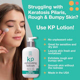 Keratosis Pilaris Treatment Lotion - 15% Glycolic Acid & 2% Salicylic Acid, Exfoliating & Moisturizing cream