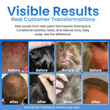 Dermasolve Psoriasis & Dandruff Shampoo + Conditioner - 8.0 oz for Itchy, Flaky Skin