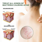 Body & Back Acne Spray with Salicylic Acid & Herbal Formula