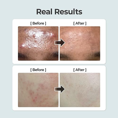 numbuzin No.1 Pure-Full Calming Herb Toner for Acne-Prone & Sensitive Skin – Centella Asiatica, Heartleaf & Licorice Root for Breakouts, Redness & Blackhead Control (10.14 fl. Oz)