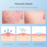 Sawanork Pimple Patches for Face - 216 Count Hydrocolloid Acne Stickers (2 Sizes)