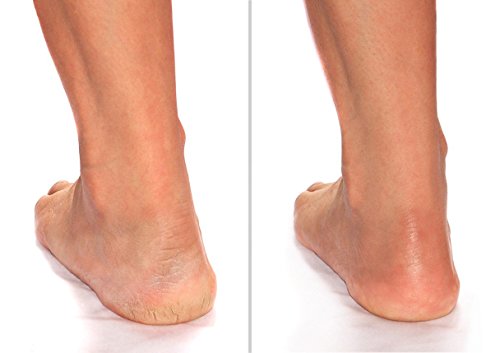 Advanced Clinicals Heel Cream - Dry, Cracked Heel Relief (8 oz)