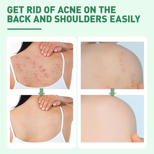 Azonee Back Acne Treatment Spray - Tea Tree, Salicylic Acid, 2% Aloe, 4 oz