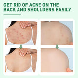 Azonee Back Acne Treatment Spray - Tea Tree, Salicylic Acid, 2% Aloe, 4 oz