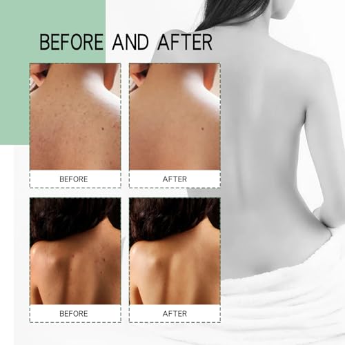 Back Acne Treatment Spray 120ml | Fade Scars, Deep Cleanse, Smooth Skin