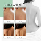 Back Acne Treatment Spray 120ml | Fade Scars, Deep Cleanse, Smooth Skin
