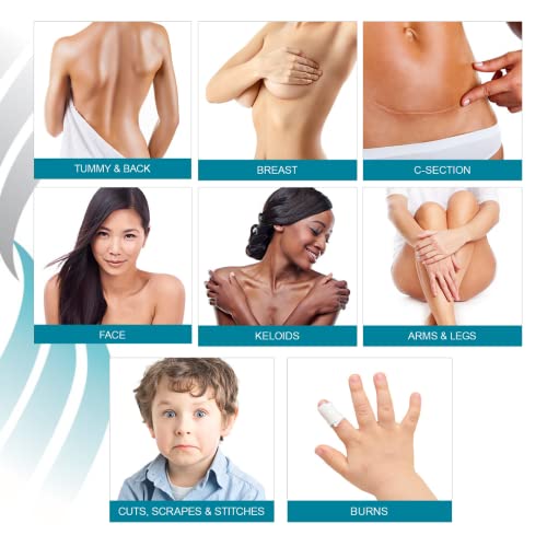 NewGel+ Silicone Scar Sheet Therapy