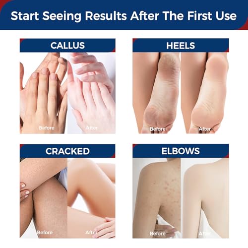 OUKEYA Urea Cream 42% with 2% Salicylic Acid - Maximum Strength Foot & Hand Cream 3oz