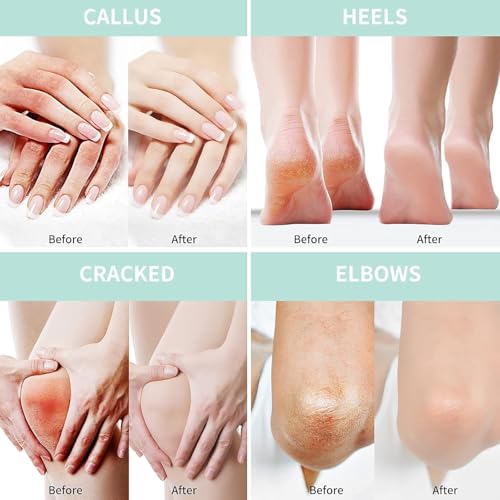YelaJoy Urea Cream 40% + 2% Salicylic Acid - Maximum Strength Foot Cream for Callus Removal & Deep Moisturization