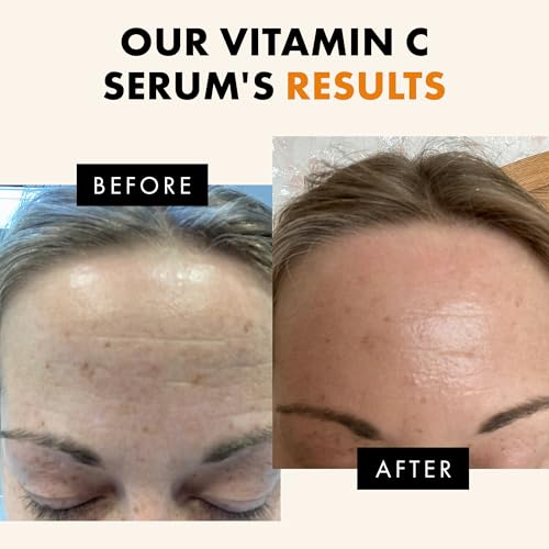 Eclat Skincare Vitamin C Face Serum - Dark Spot Remover with Hyaluronic Acid & Ferulic Acid - Anti-Aging & Skin Brightening - 100% Pure Vitamin C Serum - 1oz
