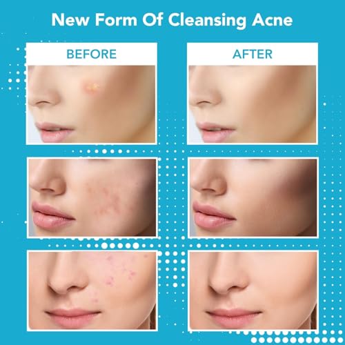 KASTWAVE Micropoint Acne Patch - 18 Patches with Advanced Anti-Acne Technology for Early Stage Blemishes