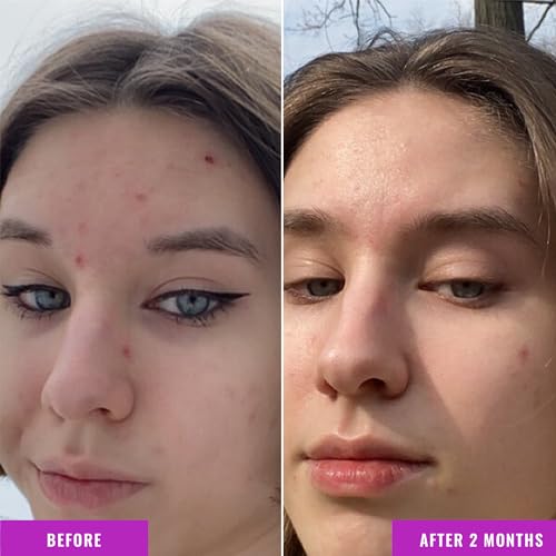 GOOD MOLECULES Niacinamide Serum - Skin Tone Corrector for Brighter, Clearer Skin - 30ml
