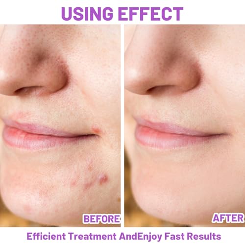 Acid Face Cream for Acne Prone Skin, Skin Brightening & Pigmentation Treatment, 20g/2