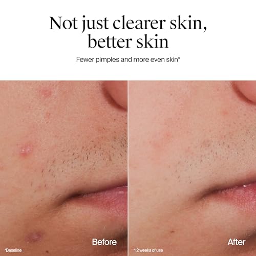 Neutrogena Oil-Free Acne Face Wash with 2% Salicylic Acid - 9.1 Fl Oz