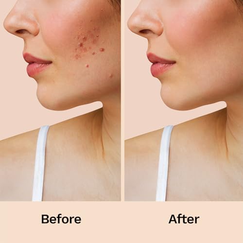 FURR Hydrocolloid Acne Relief Patches with Turmeric and Neem - Reduces Acne, Spots and Blemishes (12 Patches)