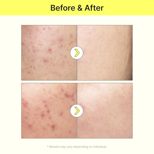 TIAM Vita B3 Source Niacinamide Serum - 10% Niacinamide & 2% Arbutin for Hyperpigmentation & Dark Spots - 1.35 Oz