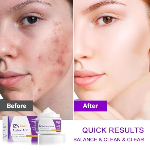 Acid Serum with Azelaic, Hyaluronic Acid & Niacinamide - Brightening Face Cream for Rosacea, Dark Spots, Redness & Pore Cleansing