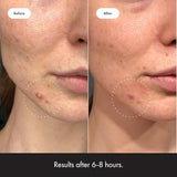 Invisible Hydrocolloid Acne Pimple Patch Ultra Thin Spot Treatment (39 Count) | Vegan & Cruelty-Free for Face & Day Use