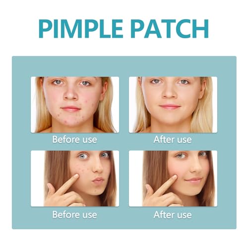 POSICHE Hydrocolloid Acne Patches 216 Pieces - Clean, Clear & Conceal Blemishes
