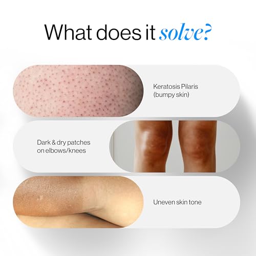 5% Lactic Acid Body Lotion - Women, Aloe Vera & Cica | Strawberry Legs Reduction, 200ml