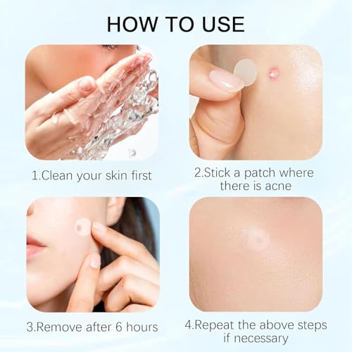 Sawanork Pimple Patches for Face - 216 Count Hydrocolloid Acne Stickers (2 Sizes)