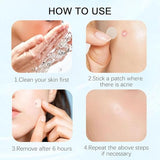 Sawanork Pimple Patches for Face - 216 Count Hydrocolloid Acne Stickers (2 Sizes)