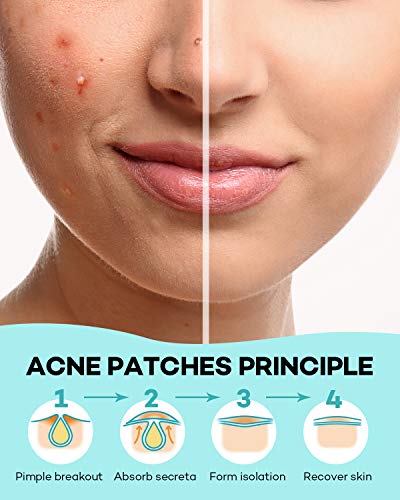 TKTK Acne Patch Pimple Patch - 4 Sizes, 140 Patches with Tea Tree & Calendula Oil