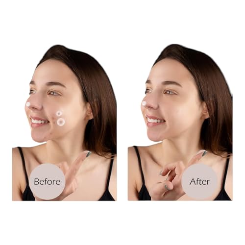 ROYAL NEEDS Acne Pimple Patch - 72 Invisible Hydrocolloid Stickers for Overnight Treatment