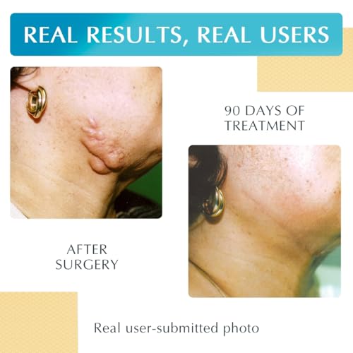 NewGel+ Silicone Gel Strips for Scar Management - Effective & Discreet