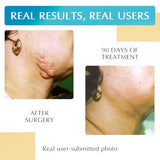 NewGel+ Silicone Gel Strips for Scar Management - Effective & Discreet