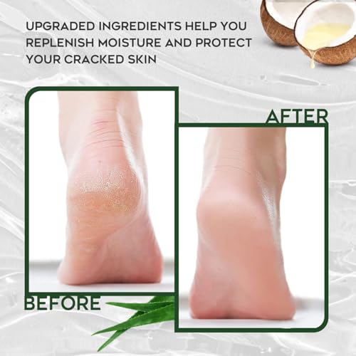 Urea Cream 42% Foot Cream with Salicylic Acid - Callus Remover for Feet, Knees & Elbows - Intensive Moisturizer & Exfoliator - 4 Oz