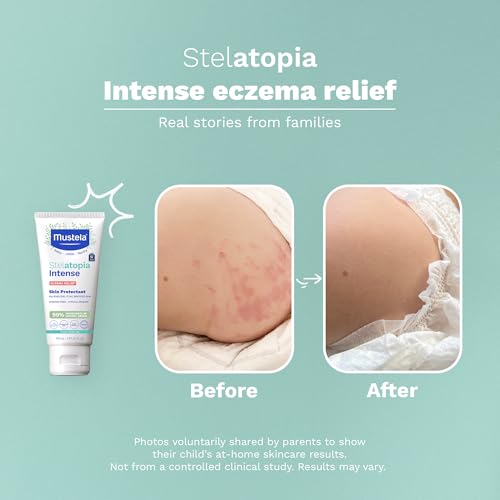 Mustela Eczema Relief Cream Stelatopia Intense Fragrance-Free Moisturizing Body Lotion