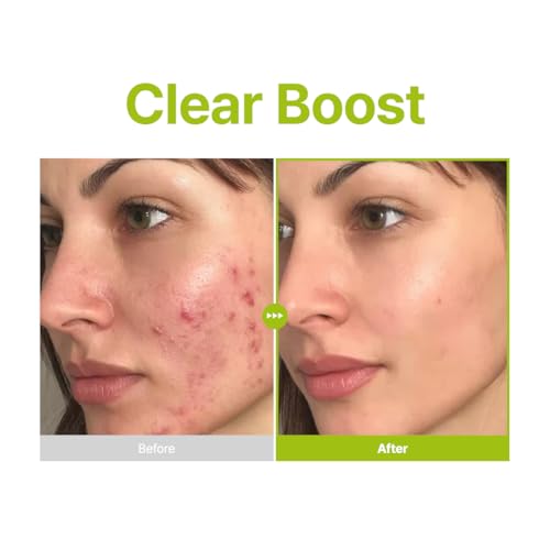 PURITO Azelaic Acid 10 Kojic Tea Tree Serum - Acne & Uneven Tone for Dermatologist-Recommended Treatment