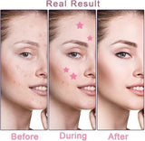 X spring Acne Patch - 126 Count Star-Shaped Hydrocolloid Patches for Face & Body