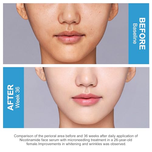 Niacinamide 10% + Zinc 1% Face Serum with B5 & Hyaluronic Acid – Pore Reducer & Acne Marks