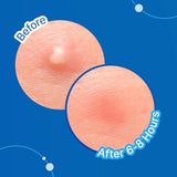 Sotrue Acne Pimple Patches - Hydrocolloid Waterproof Patches for Active Surface Acne, 36 Patches
