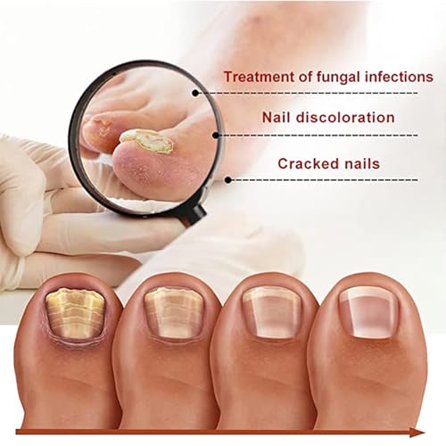 Nail Fungus Treatment Essence - Fungal Nail Repair for Toes & Ingrown Nails (20ml)