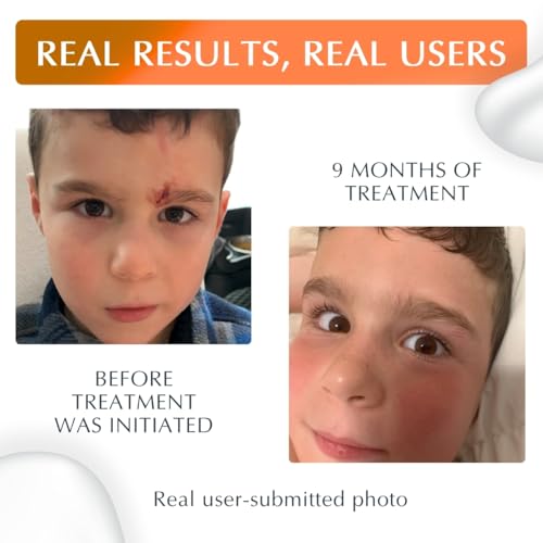 MyNewGel NewGel+UV Advanced Silicone Scar Gel SPF30