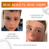 MyNewGel NewGel+UV Advanced Silicone Scar Gel SPF30