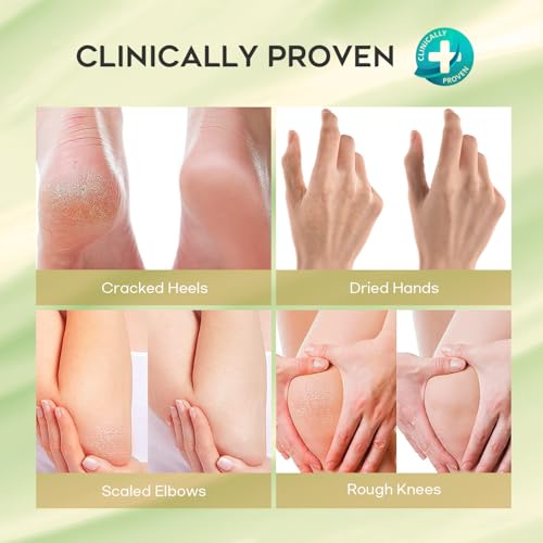 Urea Cream 42% Foot Cream with Salicylic Acid - Callus Remover for Feet, Knees & Elbows - Intensive Moisturizer & Exfoliator - 4 Oz