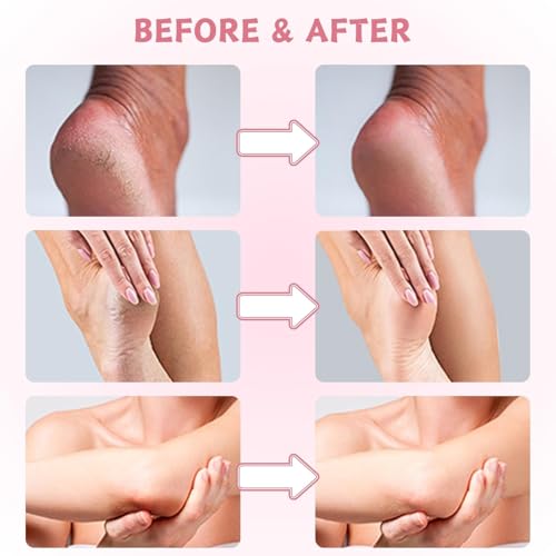 40% Urea Cream for Dry Foot & Cracked Heels - Moisturizing Repair with Hyaluronic Acid & Salicylic Acid