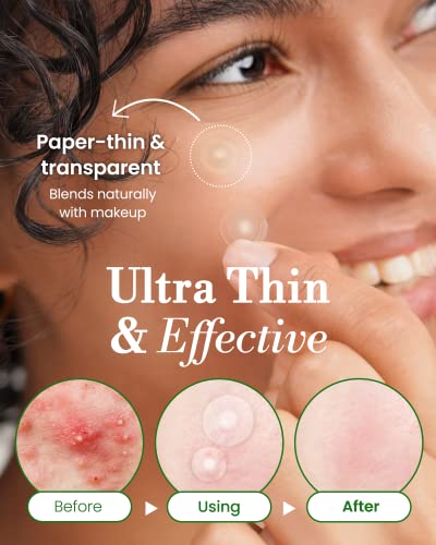 Troubless Invisible Pimple Patch Classic - 96 Ultra Thin Hydrocolloid Acne Patches for Daytime Use - Fast Healing & Oil Absorption