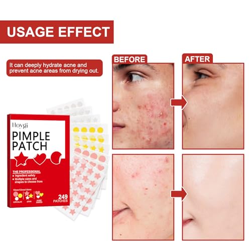 Pepisk 249-Count Multi-Shaped Hydrocolloid Acne Patches | Ultra-Thin & Invisible with Strong Adhesion for No-Makeup Looks
