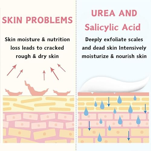 40% Urea Cream for Dry Foot & Cracked Heels - Moisturizing Repair with Hyaluronic Acid & Salicylic Acid
